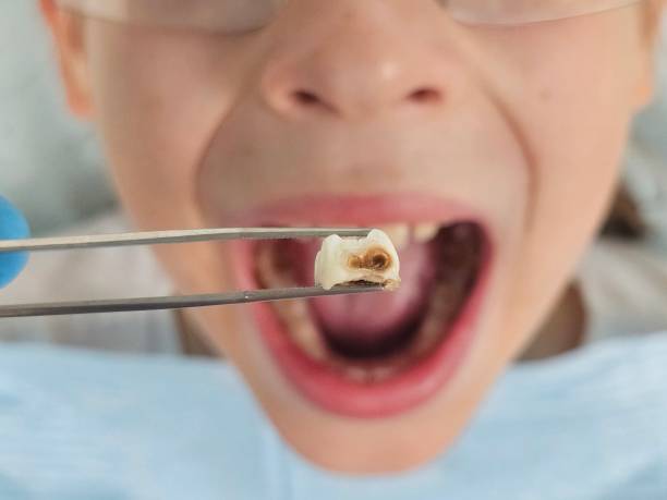 Teeth Whitening in AK